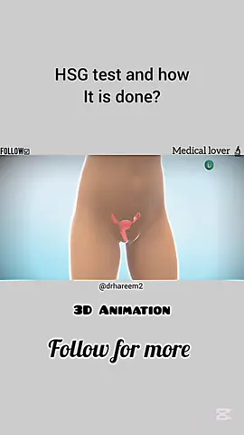 part 81 || HSG test and how it is done... #notpreezmyacount #viral_video #followers➕ #🌹💉✂🔗💊❤ #❤️🌹🌹🌱💖💫🇵🇰🌺💕💕🏵️🥀☘️☘️🌾🌬️🌻🌿🌿🌷🌷💓💓💞🌷🌬️ 