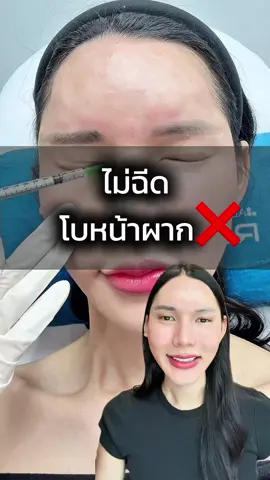 ไม่ฉีดโบหน้าผาก❌ #รีวิวบิวตี้ #botox #โบท็อกซ์ #ริ้วรอย #โบหน้าผาก 