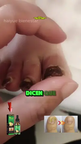¡Da nueva vida a tus uñas con nuestro sérum de jengibre revitalizante! Este innovador sérum, enriquecido con vitaminas B y extractos botánicos, está diseñado para reparar y fortalecer las uñas dañadas. Su fórmula avanzada trabaja en profundidad para restaurar la salud de tus uñas, prevenir quiebres y fomentar un crecimiento saludable. Cada aplicación te proporcionará uñas más fuertes y radiantes. ¡Un pequeño frasco, un gran efecto, y el mejor cuidado para tus uñas!#Vitaminab #Molinosharineros  #TikTok #Lasuñas #VentaQuincenal