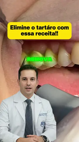 Receita para remover tártaro nos dentes#dentista #aparelho #tartaro 