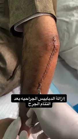 🦴 إزالة الدبابيس بعد التئام الجرح 🔩 بعد أي عملية جراحية، بنراقب الجرح بشكل مستمر… ولما يحصل الالتئام الكامل، بنبدأ خطوة مهمة: إزالة الدبابيس الجراحية. ✅ بتساعدنا على تقليل التهيّج الجلدي ✅ وتقلل فرصة تكوّن ندبة سميكة 📆 التوقيت مهم! غالبًا بين 10-14 يوم حسب مكان الجراحة وحالة المريض