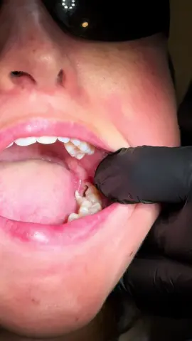 And the tooth is out… 🤩 #dentalstudents #maxillofacial #oralsurgery #dentist #dentistry #ليبيا_طرابلس_مصر_تونس_المغرب_الخليج #الامارات_السعوديه_الكويت_البحرين_عمان #extraction #wisdomteeth 