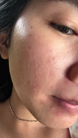 Da dầu, da mụn dùng sữa rửa mặt Laroche khỏi chê luôn nha #larocheposay #suaruamat #chamda #skincare #larocheposayvietnam 
