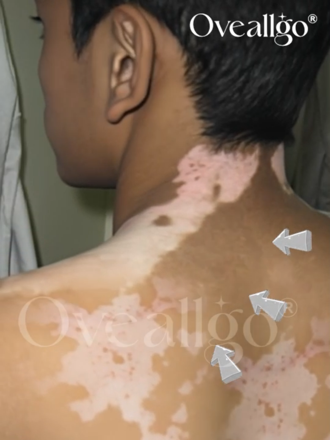 „60 % meines Gesichts waren weiß. Jetzt ist mein natürlicher Hautton zurück – und mein Selbstbewusstsein auch.“ Du kämpfst mit Vitiligo und nichts hilft wirklich? Dieses Kräuterspray bringt echte Ergebnisse – ganz natürlich. 🌱 Fördert die natürliche Pigmentierung durch Melaninaktivierung 🏠 Einfache Anwendung zu Hause, ganz ohne Arztbesuche 🛡️ Sanft & sicher – auch für empfindliche Haut ⚡ Erste Ergebnisse oft schon nach 2–3 Wochen 💬 „Nach nur 8 Tagen kam die Farbe zurück.“ – Joseph M. 💡 Gib deiner Haut eine echte Chance. 👉 Jetzt tippen und deine Veränderung starten. #Vitiligo#Hautpflege#Pigmentierung#Melanin