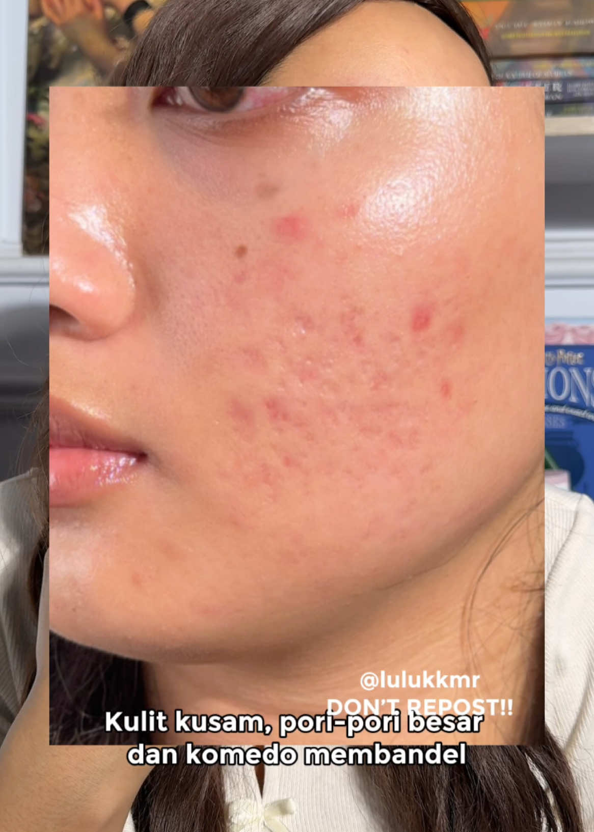 Yang punya permasalahan kulit kusam, gradakan dan komedo membandel. Wajib cobain peeling serum @SkinGenius ini deh! #fyp #skincare #acneskin #acnepositivity #acnefighter #acnejourney #makeup #acnemakeup #acneproneskin #scars #peelingserum #eksfoliasi #exfoliate #komedo #blackheads #whiteheadsremoval #poriporibesar #largepores 
