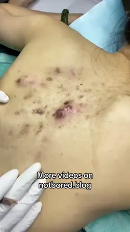 For more videos : notbored.blog Blackhead removal / Pimple popping / Pimple Patch  #pimple #popping #blackhead #zit #acne    