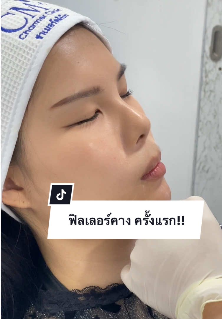 ฟิลเลอร์คางครั้งแรก แต่ผลลัพธ์คืออึ้ง! #รีวิวบิวตี้ #ฉีดฟิลเลอร์ #ฟิลเลอร์ #filler 