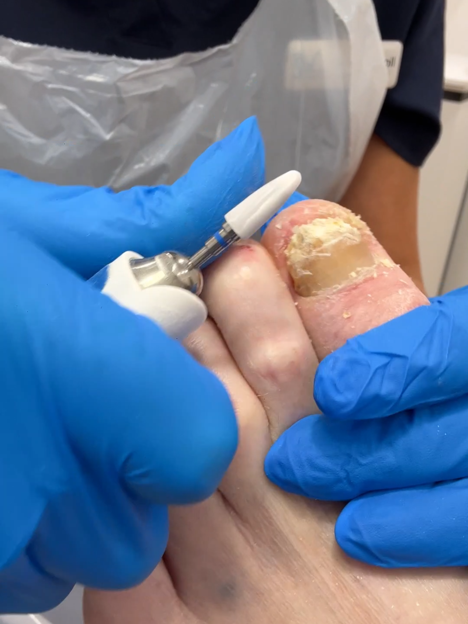 This fungal nail didn’t stand a chance 😮‍💨 Nippers first, then the burr = super satisfying Not everyone wants full treatment—some just want comfort 👣 #FungalNail #ToenailTransformation #FootTok #PodiatryTikTok #NailCare #OddlySatisfying #BeforeAndAfter #SWPodiatry
