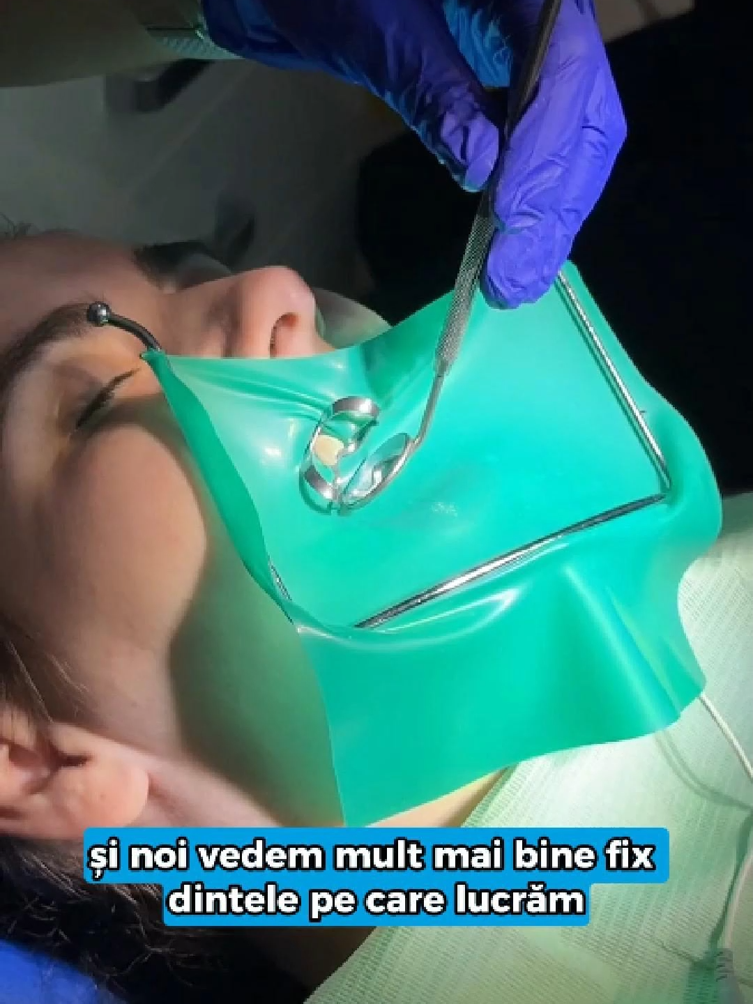 🦷 Știai că tratamentele de canal (scoaterea nervului) se pot face complet fără durere și într-un mod super sigur? La Denta Clinic, folosim tehnici moderne și izolare perfectă cu digă, ca să ne asigurăm că totul se face curat, precis și confortabil pentru pacient. 👉 Începem cu anestezie locală, urmată de o pregătire atentă a canalelor cu instrumente speciale, rotative și manuale. 🛡️ Digă = protecție totală, atât pentru pacient, cât și pentru medic. 💧 Spălăm și dezinfectăm canalele cu soluții speciale, fără riscul ca ceva să ajungă în gât sau să scape din control. Totul se face în liniște, cu empatie și răbdare. Pacienta? A rămas fără nerv, dar cu zâmbetul pe buze 😄 📞 WhatsApp: +40 761 233 220 📍 Râmnicu Vâlcea – Calea București 193A 🌐 www.dentaclinic.ro 🔗 linktr.ee/dentaclinic.vl