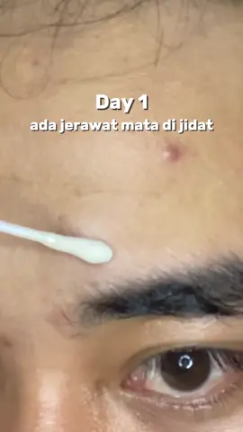 #obatjerawat #obattotoljerawat #acnefighter #jerawat #omniskin #vocanicash 