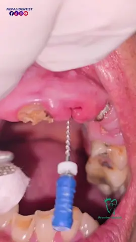Easy technique to remove a rootstump #technologia #toothremoval #dentistry #technique #dentalclinic 
