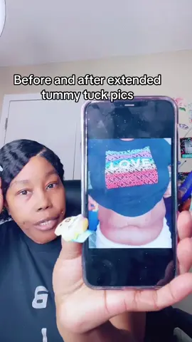 #tiktoklive #livehighlights before and after tummy tuck pics #tummytuck 