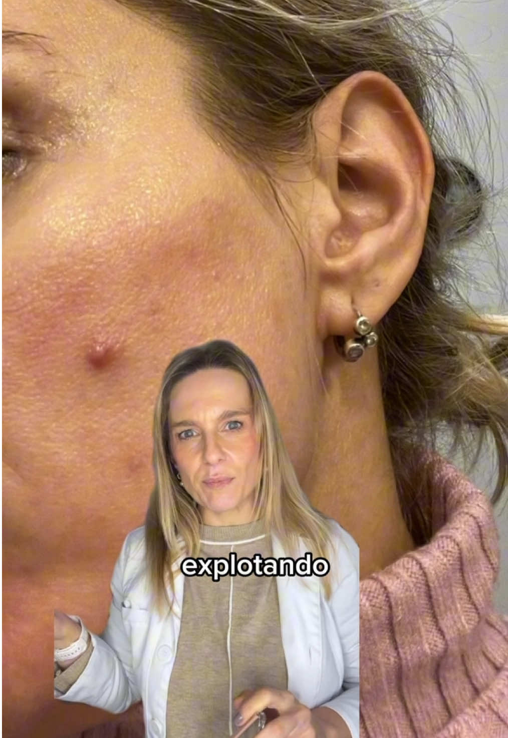 Los nuevos parches Effaclar Duo +M de @La Roche-Posay son la solución para ese granito puntual que te sale y tanto te molesta!  Siempre con una buena rutina antiacné como te muestro en el video, y acompañando al tratamiento que te indique tu dermatólogo.  Contame qué haces con los granitos!  #noloexplotes #drazaidatroyano #dermatologaargentina #dermatologacordobesa #acne 