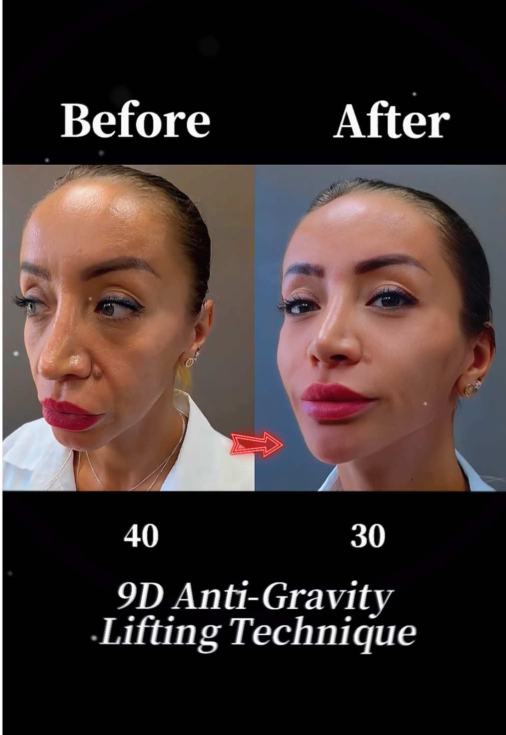 #facelift #antiaging #facelifting #plasticsurgery ‎#تركيز الوجه#拉皮手术 