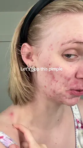 Body acne 🙃 @Acne Girly #pimplepop #pimplepopping #bodyacne #bodyacnetreatment 