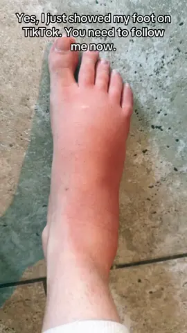 Started bee venom therapy and got stung on my foot… didn’t expect this much swelling 😳 But this is actually a normal part of the process! Your body’s learning, adapting, healing. I’m resting, elevating, and trusting the journey 💛🐝 #BVT #BeeVenomTherapy #ApitherapyJourney #NaturalHealing #AutoimmuneSupport