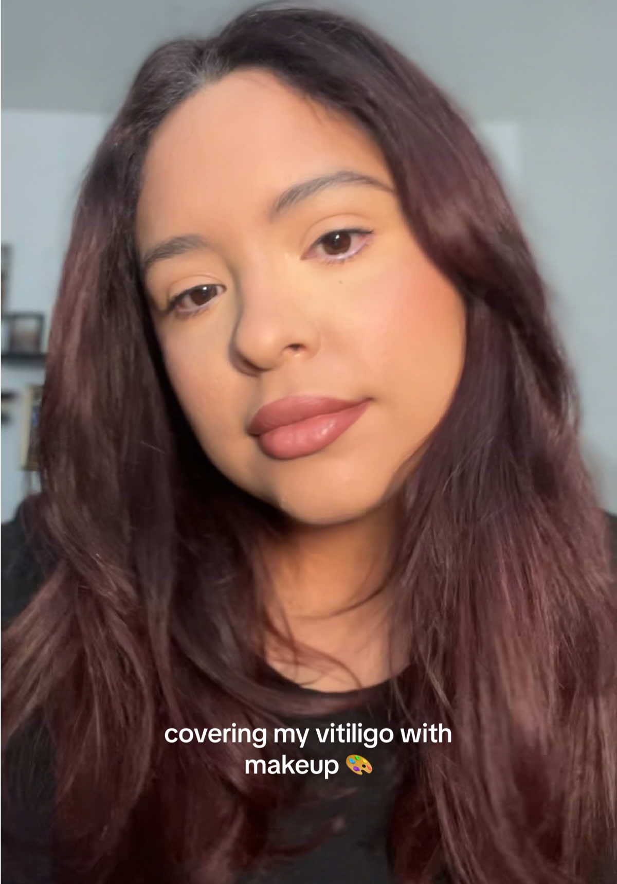 covering my vitiligo with makeup yet again 👩‍🎨  #vitiligo #makeup #fyp 