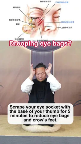 Drooping eye bags?#droopy #eyebag #eyebags #painrelief #healthy #wellness #tcm 