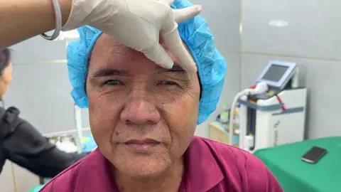 Treo cung mày 