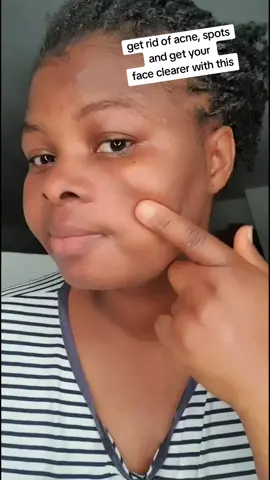 get rid of acne,spots and get  your face clearer with this #skincare 