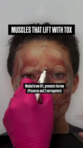 I love using neurotoxin to balance facial asymmetry ❤️