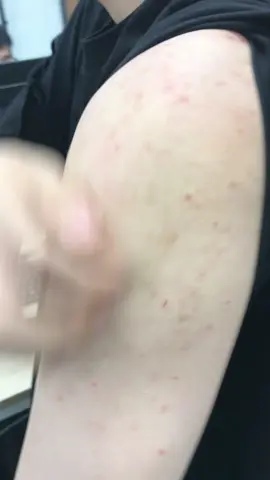 Free yourself from itch! Loved by millions, this cream soothes in 7days, grab it before it’s gone! #skincare #eczema #psoriasis #herbalcream #sensitiveskin #skintok #herbalskincare #skincareessentials #beforeandafter #tiktokmademebuyit #68 #tiktokshop 