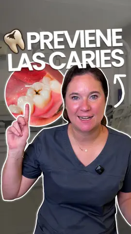 ¿Tienes una manchita negra en un diente? ¿Un agujerito? ¿Te duele alguna muela? Puede que sea una caries. ¿Qué podemos hacer para evitarla? ✅ Cepillado mínimo 3 veces al día ✅ Hilo dental al menos 1 vez al día ✅ Reducir azúcares y carbohidratos ✅ En niños y adolescentes: comida dura o fibrosa como manzana o zanahoria para ayudar a limpiar la placa (sobre todo cuando el cepillado no es tan bueno…)