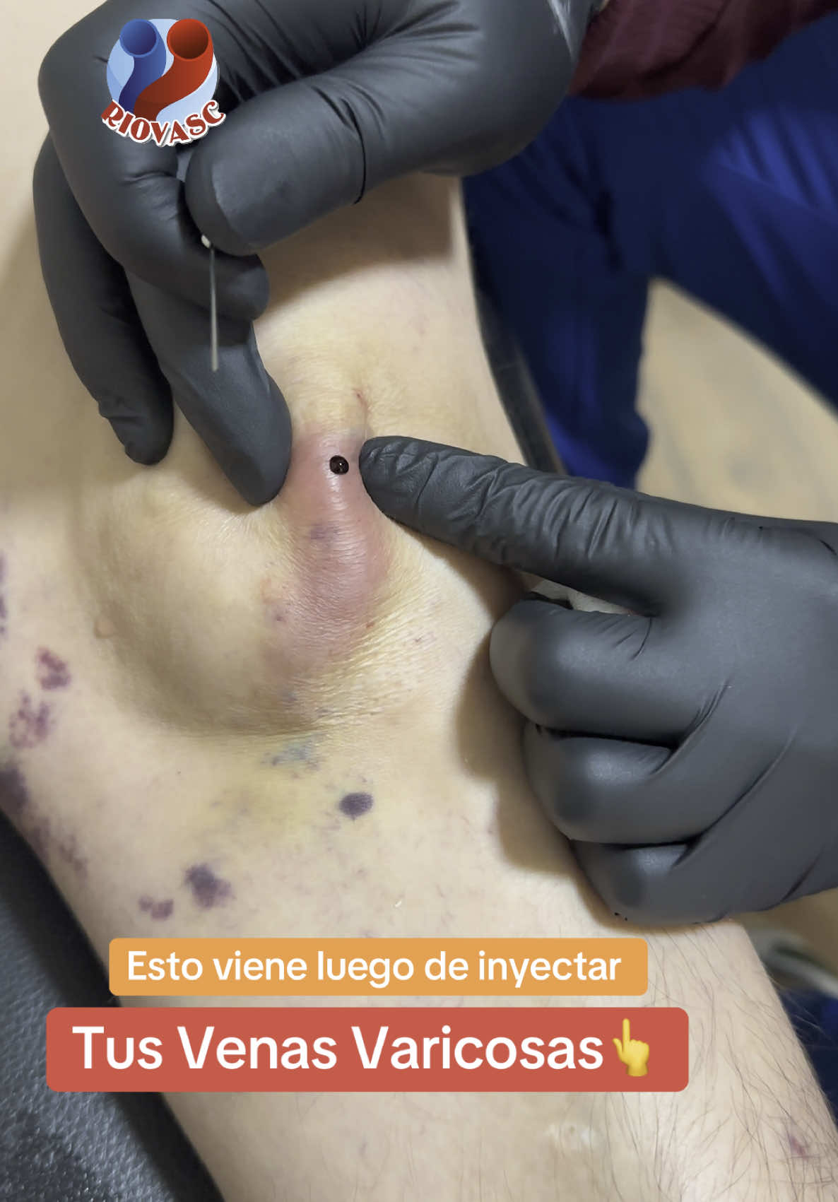 🏩 La Escleroterapia ☺️👆 es un excelente método para eliminar tus Várices, se realiza en el consultorio médico , no se hacen cortes , no deja cicatrices y te incorporas de inmediato a tus actividades @The Vein Doctor 👨‍⚕️ 👉 Riovasc 👈📲+593995178395/+593958757917 #escleroterapia #varices #varicesenlaspiernas #venasvarices #varicesyarañitas #arañasvasculares #paratii #parami #cirugiavascular #cristianbravo148 