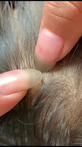 😱#omg #lice #liceremoval 