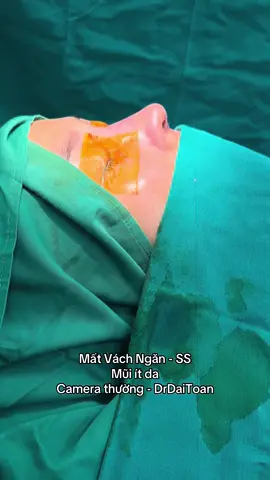 Mất Vách Ngăn - SS  Mũi ít da  Camera thường - DrDaiToan #đạitoàn #daitoan 