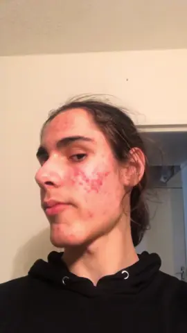 avant après roaccutane #fyp 