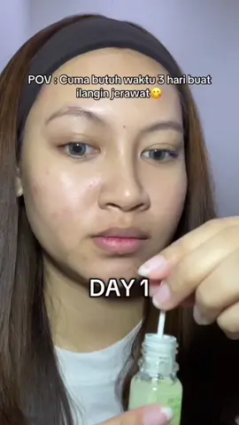 ini best affordable acne lotion yang aku punya🥹 bener bener se ngaruh itu buat jerawat aku yang mateng❗️🥰💗✨ #obattotoljerawatg2g #obattotolviral #beautyenthusiast #acneskincare 