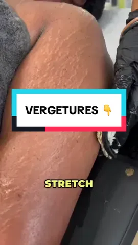C’est quoi des vergetures ? C’est un craquement profond de l’épiderme. Mais est-ce qu’il ya une solution face aux vergetures ? 👉 OUI !  Bien sûr les vergetures ne peuvent pas disparaître à 100% Notre peeling aux algues REAL MIRACLE ! Il permet d’améliorer celles-ci de manière considérable! Elles seront plus lisses, fine, moins visibles pour une peau plus raffermie 🌿  Et toi ma woman ? Tu souhaites traiter tes vergetures ?  #stretchmarks #hyperpigmentation #stretchmarkremoval #newskin #peeling #peelingauxalgues 