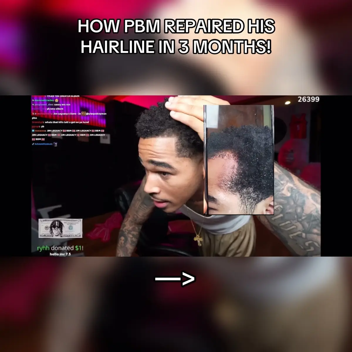 #Hairline #Hairlossmen #plaqueboymax 