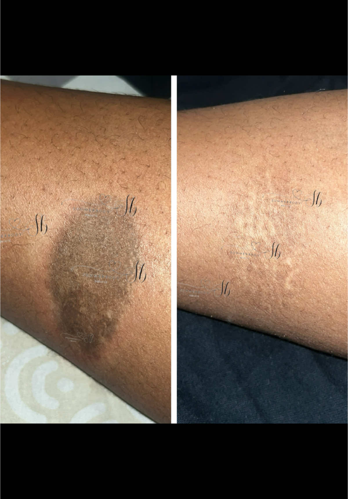 Je suis tellement heureuse pour elle, la force de notre produit anti-taches est magique 😍😍😍 jambes noires eliminer les taches noirs tache noir trend tache produit tache acne tache noir sur le corps enlever les taches hyperpigmentation eliminer les taches noirs j'ai une tache Tache jambe #hyperpigmentation #tache #cicatrices  #scar #eliminerlestachesnoires #tachesbrunes #entrejambesnoires 