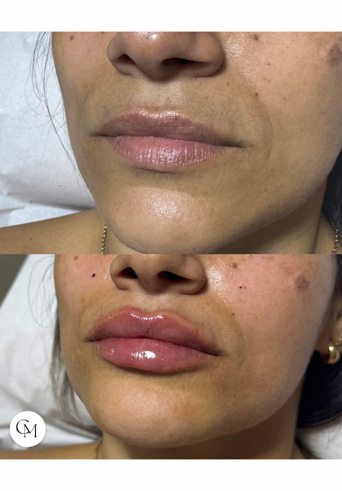 Pós imediato de preenchimento labial Logo após a aplicação é normal os lábios ficarem inchados e com mais volume do que o resultado final. Isso acontece porque o ácido hialurônico atrai água e há um pequeno edema pelo trauma das microperfurações. 17 Em até 48 a 72 horas, o inchaço reduz e os lábios começam a mostrar o formato real e natural que foi planejado. V Confie no processo e siga as orientações do seu profissional. O resultado final sempre vale a pena! #PreenchimentoLabial #LábiosPerfeitos #ÁcidoHialurônico #EstéticaAvançada #HarmonizaçãoFacial #CarlaMonteiroEstética #LábiosNaturais #EstéticaComSegurança #PreenchimentoComResponsabilidade #SaúdeeBeleza #Lábios #InchaçoNormal #ConfieNoProcesso #EstéticaRJ #SãoGonçaloEstética #belezanatural 