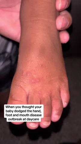 2/3 kids have it now 😩
