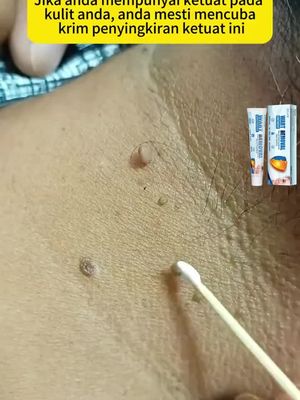 This wart cream removed the warts on my skin.