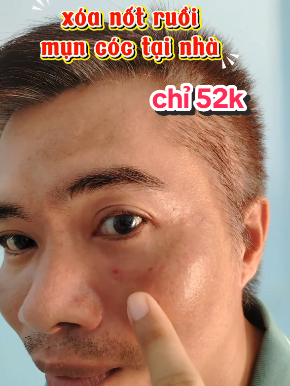 gel xóa nốt ruồi, mụn cóc bánh bao... là chân ái để chỉnh chu nhan sắc. #gelxoanotruoi #tachtrinh79  #xoamuncoc  #xoanotruoibanhbao  #xoanotruoi  #lamdep 