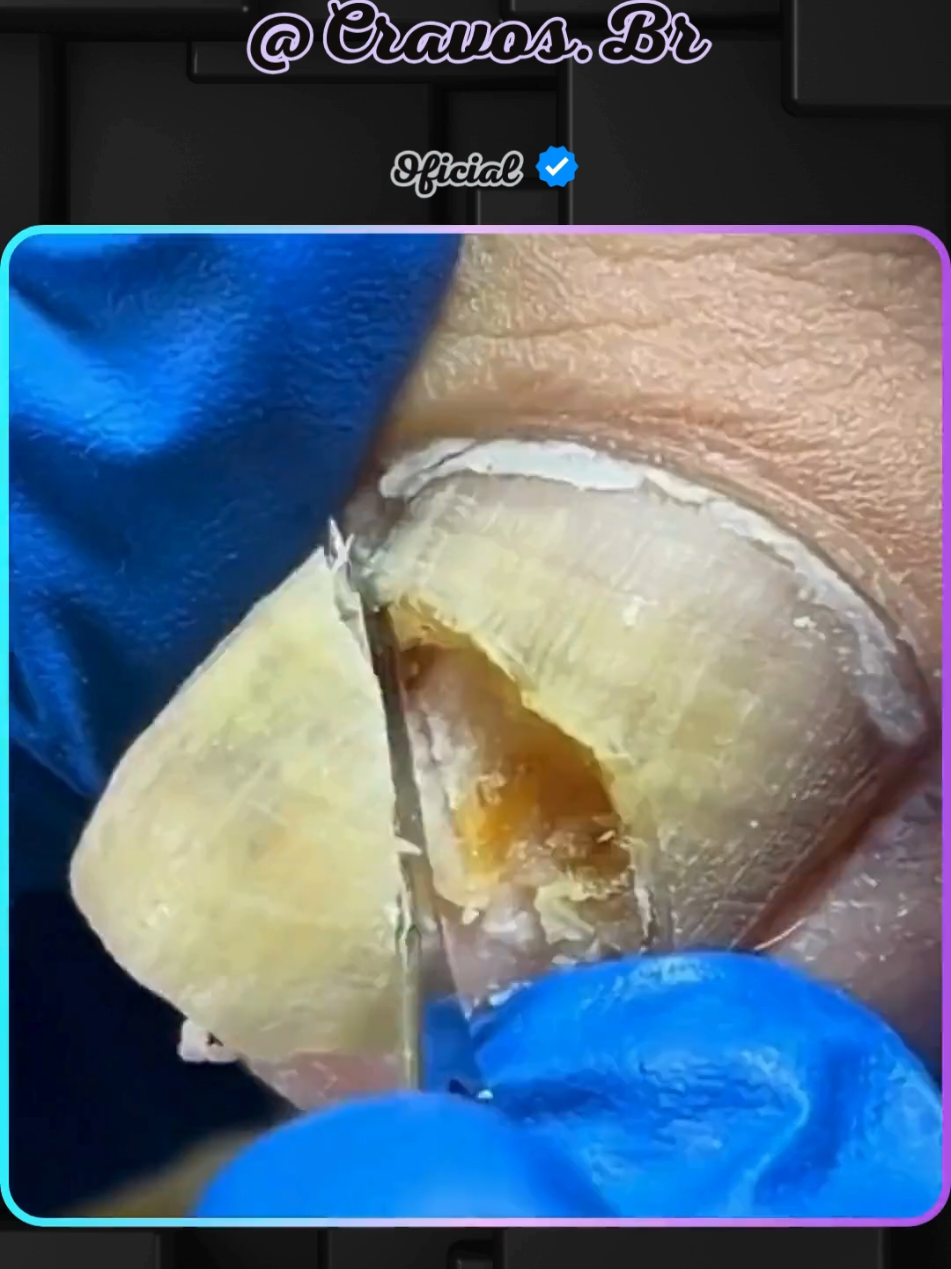 Tratamento 1290 - #unhas #pedicure #podologia #tratamento 