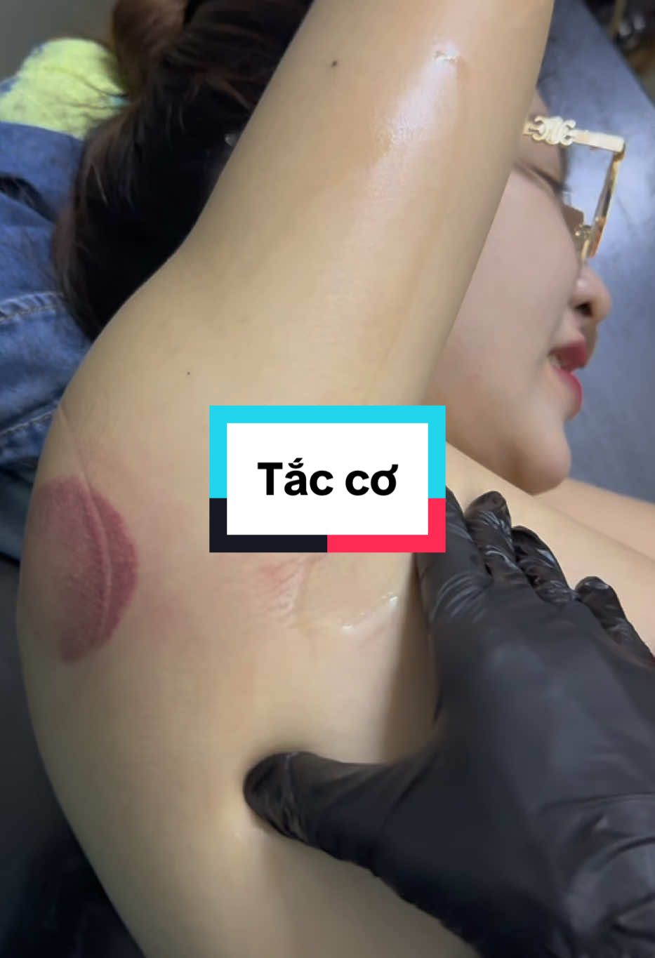 Tắc cơ 