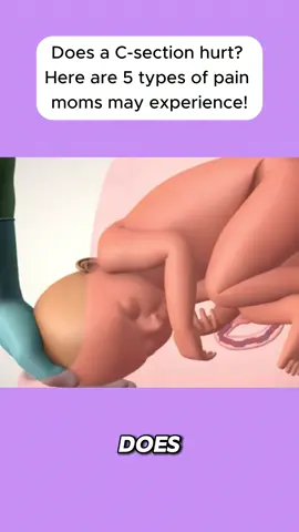 Does a C-section hurt? Here are 5 types of pain moms may experience! #pregnancy #pregnant #pregnancyjourney #pregnantbelly #pregnantlife #momtobe #pregnantmama #mompregnant #pregnanttiktok #pregnantok #viralvideo #viral 