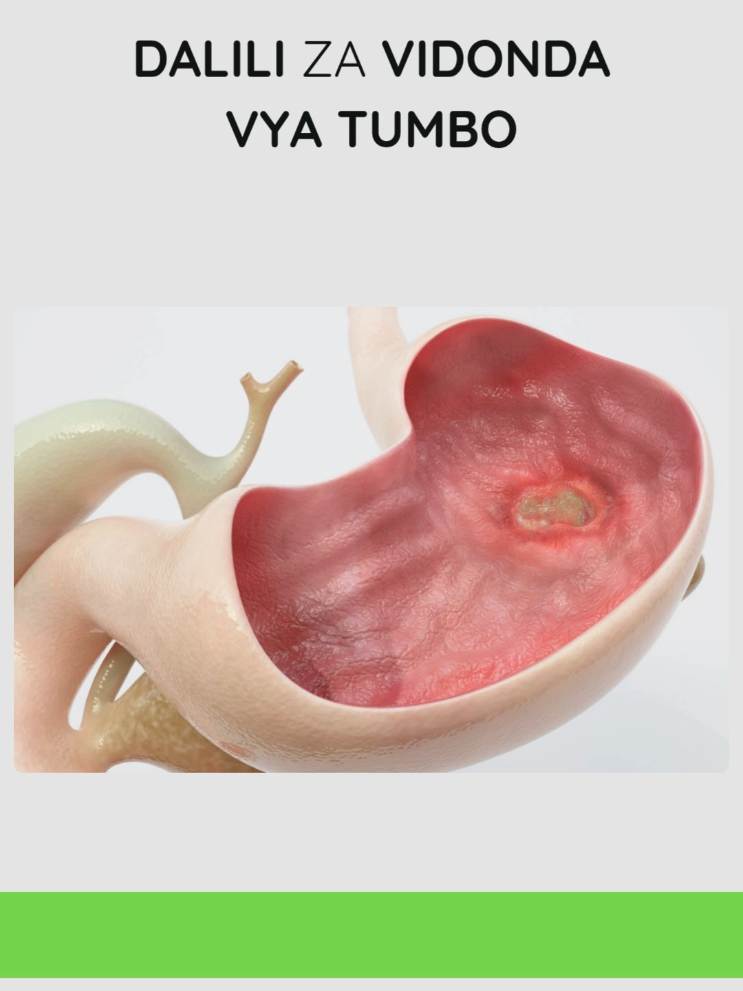Dalili za vidonda vya tumbo #foryou #swahilitiktok #tanzania #kenya #daressalaam #dalilizamimba #tibaasili #fyp #faidazatangawizi #tangawizi #ginger #dalilizavidondavyatumbo #vidondavyatumbo #pepticulcer