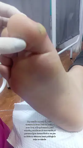 #chincha #verrugaplantar #granuloma #luzmipodologia👣💕 #chincha 