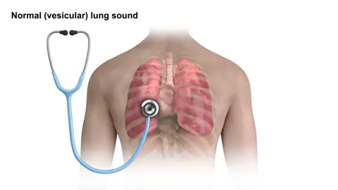 Rhonchi - a type of low-pitched lung sound called rhonchi.
