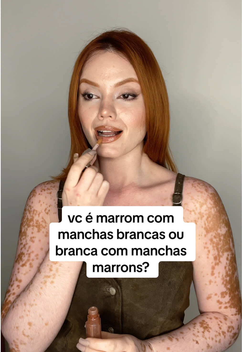 impossível não se sentir o Martin de Madagascar 🦓👀 #vitiligo #vitiligouniversal #trend #duvidas 