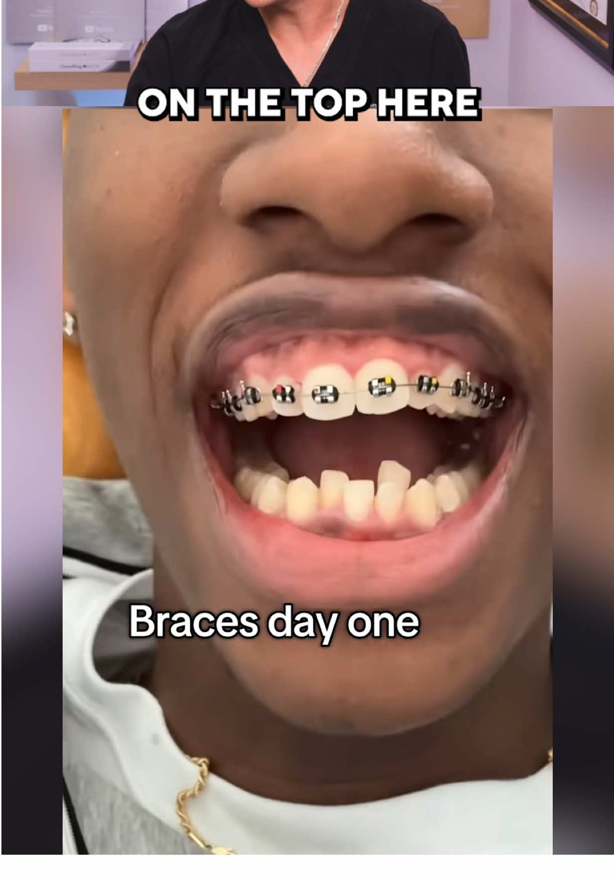 This Braces Transformation Is CRAZY! 😮🦷 #braces #teeth #dentist 