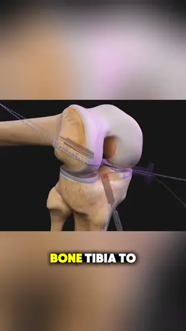 Acl Surgery (3D Animation)                    #acl #aclsurgery #aclrecovery #ligament #tears #sports #surgery #surgeon #doctor #arthroscopic #arthroscopicsurgery #hamstrings #tendon #patellar #graft #drill #bone #tibia #screws #jump #medical3danimation #3dmedicalanimation 