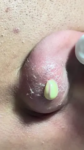 #spa #beautify #squeezingpimples #skincare #asmr 
