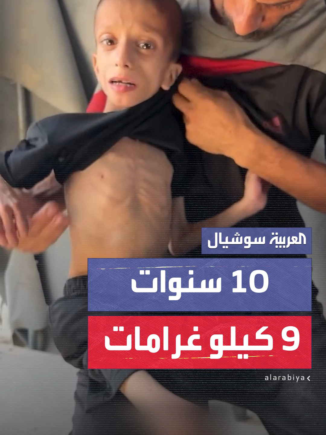 الطفل نافذ ناصر بغزة عمره 10 سنوات ويزن 9 كيلو غرامات.. يعاني من إعاقة فاقمها سوء التغذية الحاد.. وعائلته تناشد لإخراجه من القطاع #العربية #فلسطين #غزة
